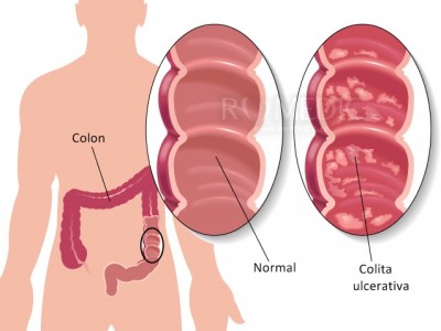 ScÄderea Ã®n greutate poate indica probleme digestive, precum colita ulcerativÄ